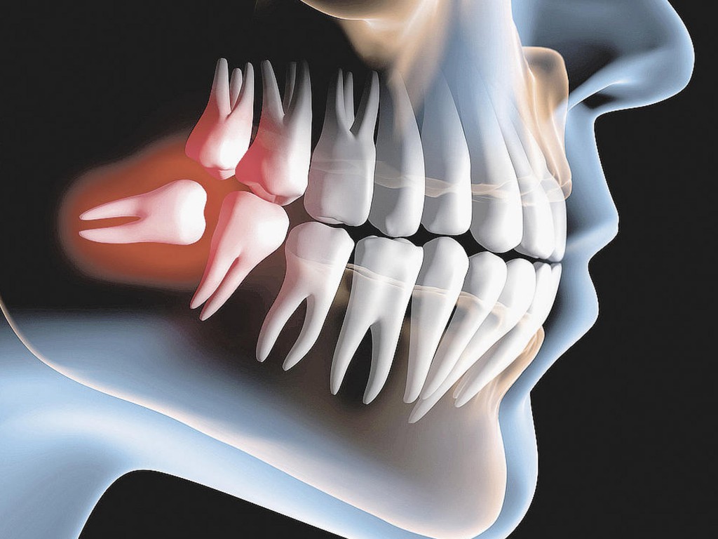 odontocape-dente-incluso-1024x768