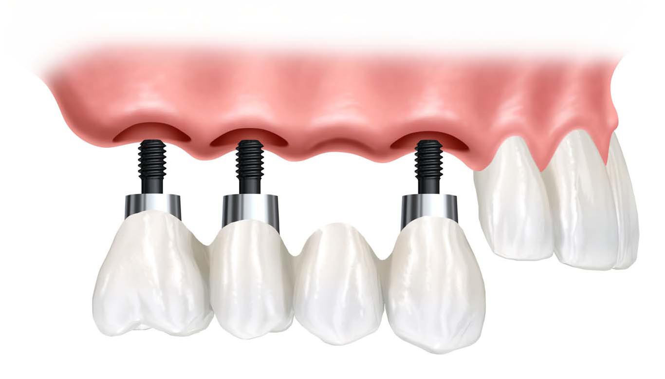 Implantes Dentários Curitiba