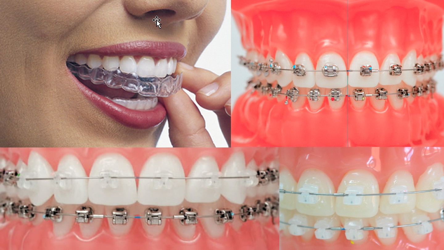 Aparelho ortodôntico invisível: corrigir os dentes sem aparelho fixo é  possível - Ortodontia Curitiba